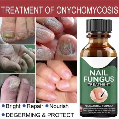 Fast Nail Fungus Treatment Serum �Nail Repair Essence for Finger & Toenail Care (All-Natural Formula)