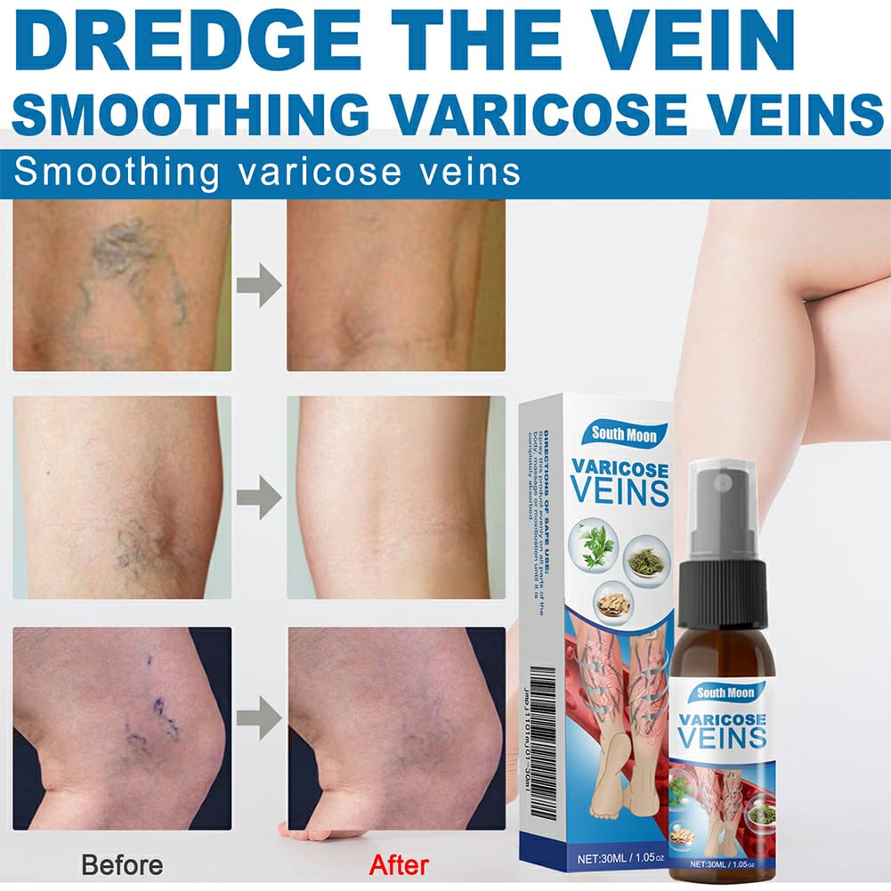 Varicose Veins Treatment Spray �Advanced Formula for Spider Veins, Leg Pain & Swelling Relief ~ 30ml