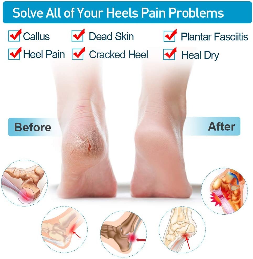Silicone Heel Protector Sleeve for Cracked Heels & Pain Relief �Breathable & Cushioned Support