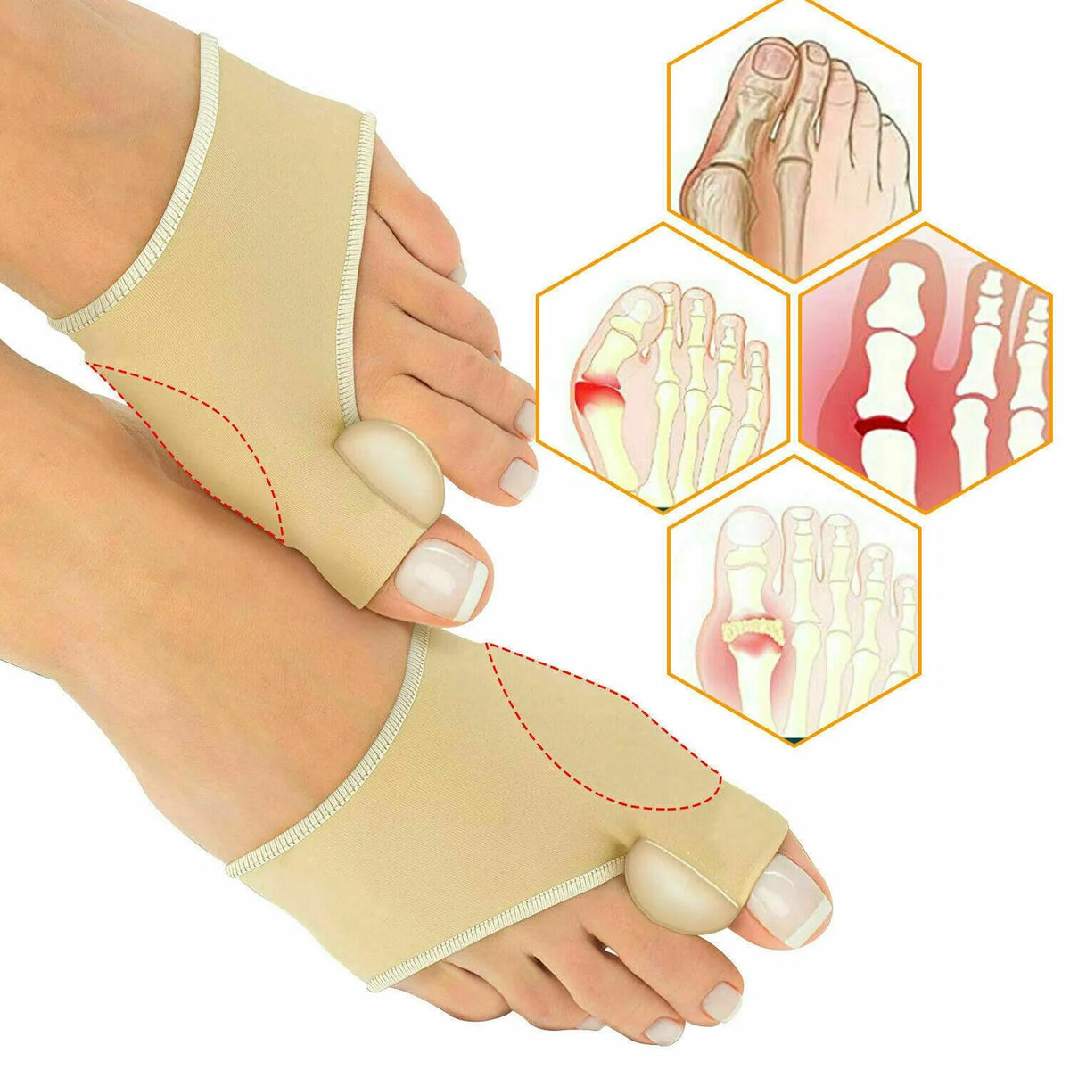 Smart Care Bunion Support Foot Mate Correction – photo 2