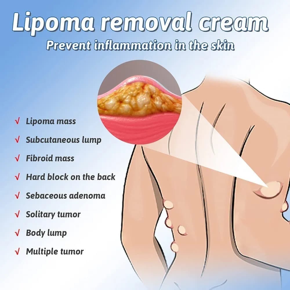 South Moon Lipoma Removal Cream (50g) | Natural Herbal Ointment for Body Lumps & Skin Knot Relief | Professional Skin Smoothing Formula