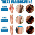 Varicose Veins Treatment Spray �Advanced Formula for Spider Veins, Leg Pain & Swelling Relief ~ 30ml