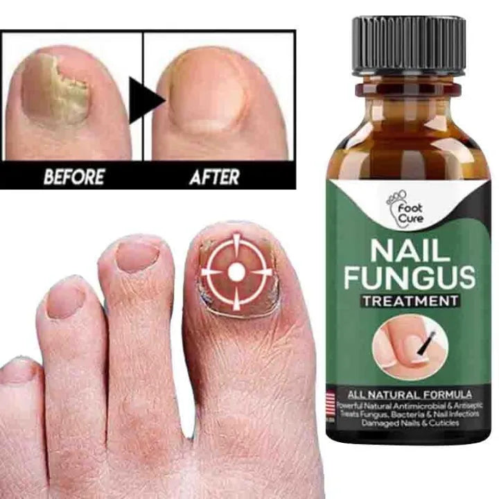 Fast Nail Fungus Treatment Gel �Nail Repair Essence Serum for Healthy, Smooth & Strong Nails