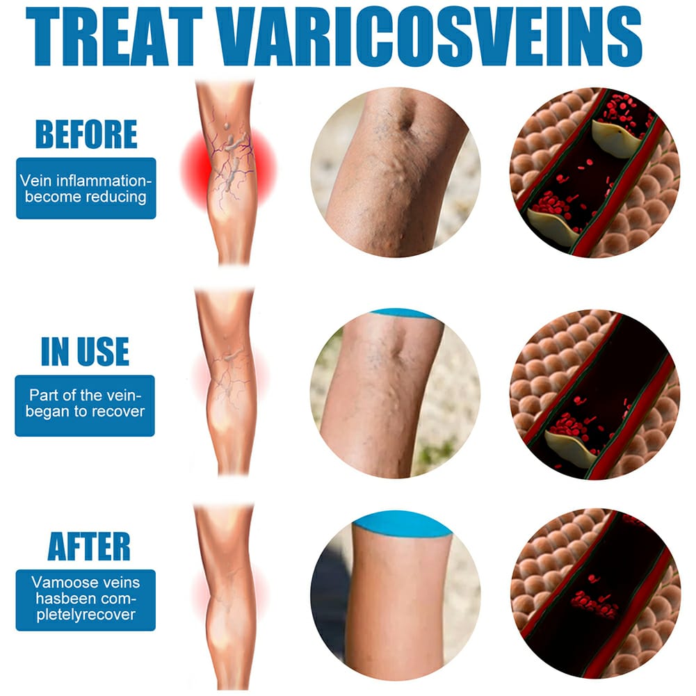 Varicose Veins Treatment Spray �Advanced Formula for Spider Veins, Leg Pain & Swelling Relief ~ 30ml