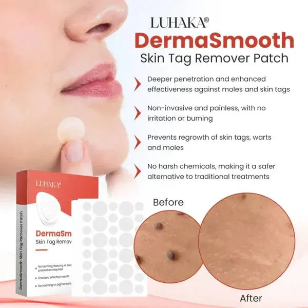 DermaSmooth Skin Tag Remover Patch �Fast, Safe, And Painless Skin Tag And Mole Removal Solution With No Scarring Or Pigmentation