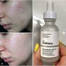 The Ordinary Niacinamide 10% + Zinc 1 % - 30ml |Oil Control, Pore Minimizing &amp; Blemish Solution Serum