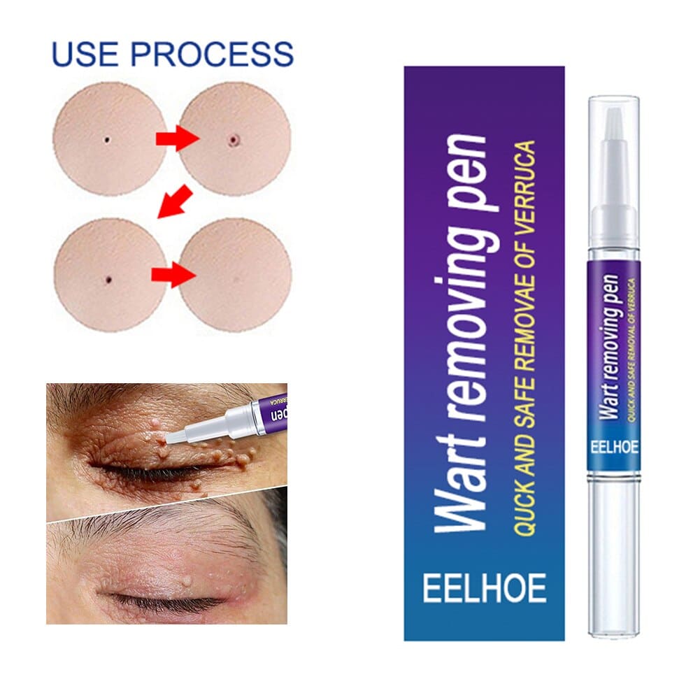 Warts Remover Original Cream Wart Removal Ointment – photo 2