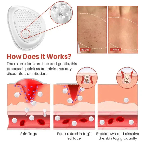 DermaSmooth Skin Tag Remover Patch �Fast, Safe, And Painless Skin Tag And Mole Removal Solution With No Scarring Or Pigmentation