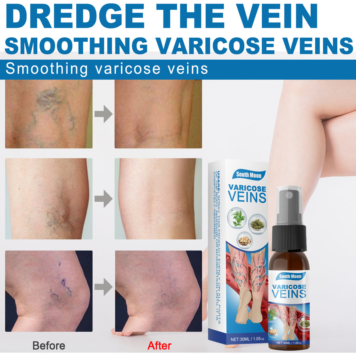 30ml Varicose Veins Treatment Spray Varicose Vein – photo 2
