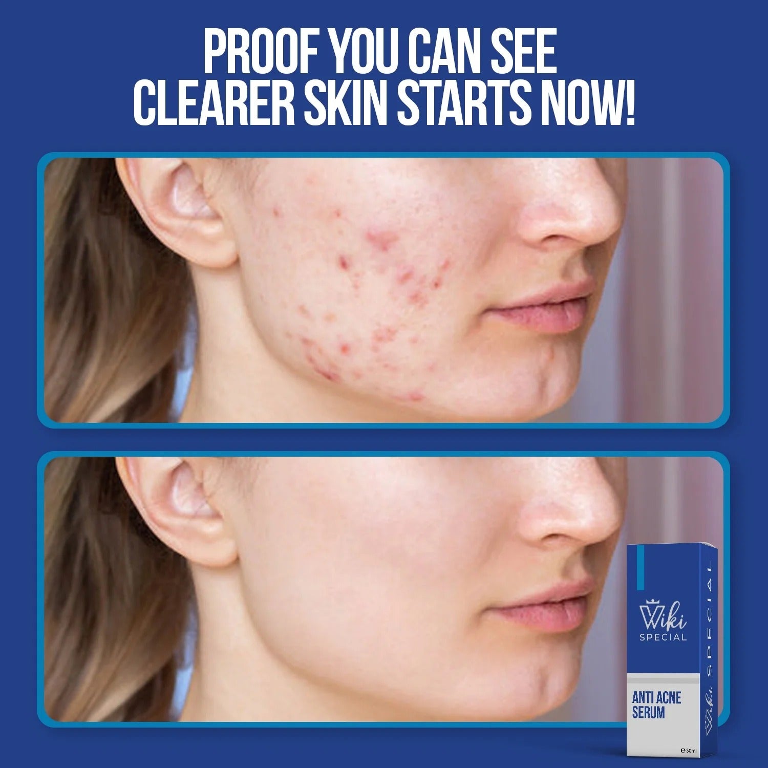 Wiki Special Anti Acne Serum �30ml | Clears Acne, Soothes Skin &amp; Fights Blemishes
